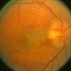 Leber's Stellate Maculopathy